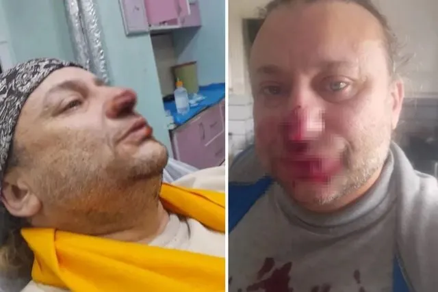 Onur Akay, başıboş pitbull köpeğinin saldırısında yaralandı